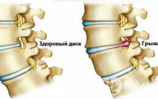 Может ли рассосаться межпозвоночная грыжа?