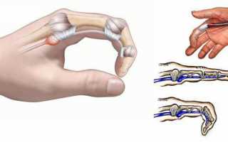 Признаки и лечение стенозирующего лигаментита