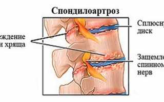 Что такое спондилоартроз?