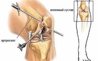 Осложнения после артроскопии колена