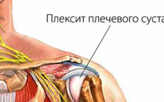 Плечевой плексит