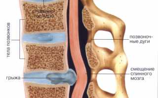 Онемение ног при межпозвоночной грыже
