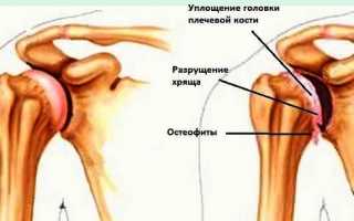 Хондроз плеча