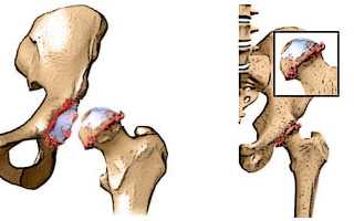 Коксартроз таза