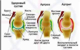 Чем отличается артроз от артрита?