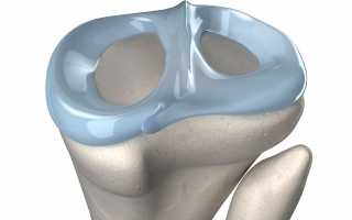 Как лечить мениск в домашних условиях?