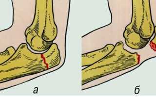 Перелом отростка локтя со смещением