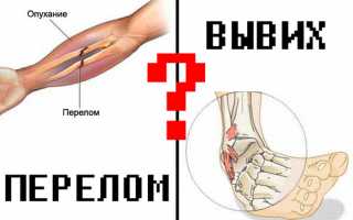 Как отличить перелом от вывиха?