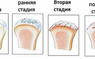 Артроз 3 стадии