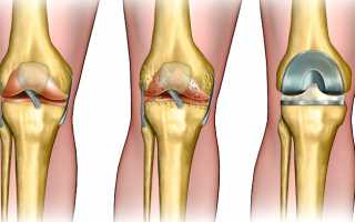 Одномыщелковое эндопротезирование сустава