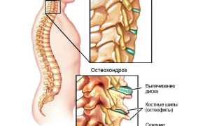Причины, симптомы и лечение шейного остеохондроза