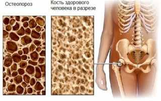 Климактерический остеопороз