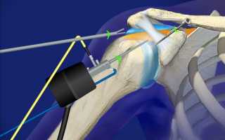 Артроскопия плеча