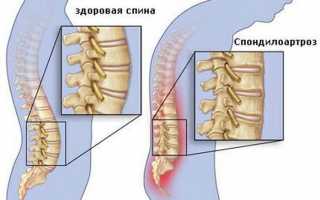 Стадии и лечение анкилозирующиго спондилоартроза