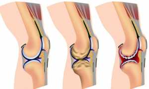 Гимнастика и ЛФК при артрозе коленного сустава