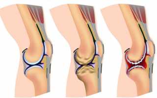 Гимнастика и ЛФК при артрозе коленного сустава
