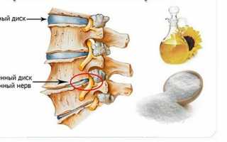 Соль при остеохондрозе