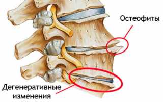 Поясничный спондилез