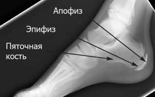 Апофизит пяточной кости