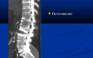 Остеомиелит позвонков