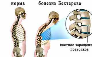 Болезнь Бехтерева и наследственность