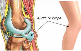 Причины и лечение кисты Бейкера