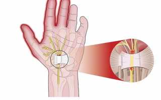 Симптомы и лечение тендовагинита кисти