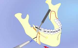 Остеотомия нижней и верхней челюсти