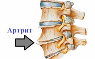 Артрит спины
