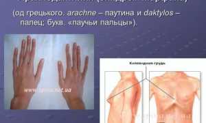 Синдром паучьих пальцев