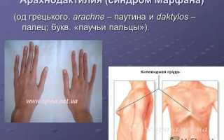 Синдром паучьих пальцев