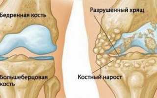 Субхондральное склерозирование