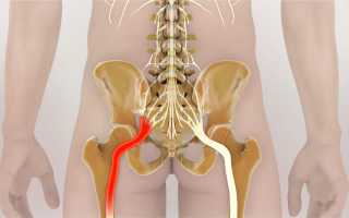 Причины и лечение неврита седалищного нерва