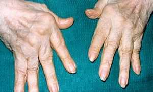 Ревматоидный полиартрит рук или ног