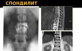 Спондилит при туберкулезе