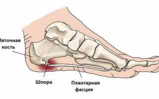 Шпора на пятке у ребенка