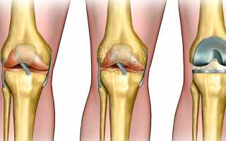 Гонартроз и другие болезни суставов