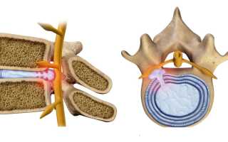 Симптомы и лечение диффузного остеохондроза