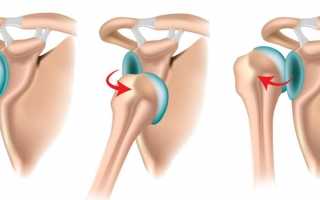Подвывих сустава плеча