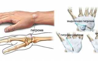 Гигрома на запястье