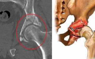 Виды и лечение переломов вертлужной впадины