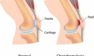 Причины боли в области коленной чашечки