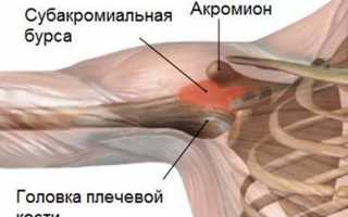 Симптомы и лечение субакромиального бурсита