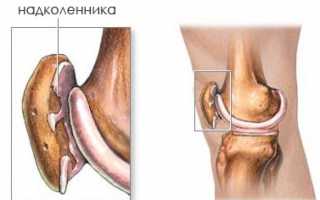 Симптомы и лечение хондромаляции надколенника