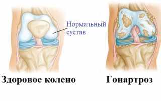 Гонартроз третей степени