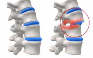 Смещение диска позвоночника
