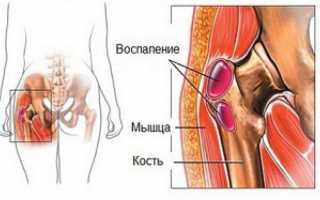 Симптомы и лечение вертельного бурсита