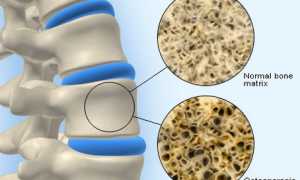 Способы лечения остеопороза в домашних условиях