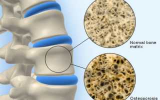 Способы лечения остеопороза в домашних условиях