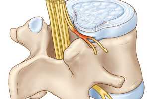 Грыжи, остеохондроз и протрузии дисков